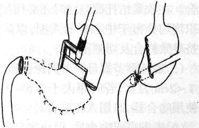 三、胃肠吻合器的常用术式